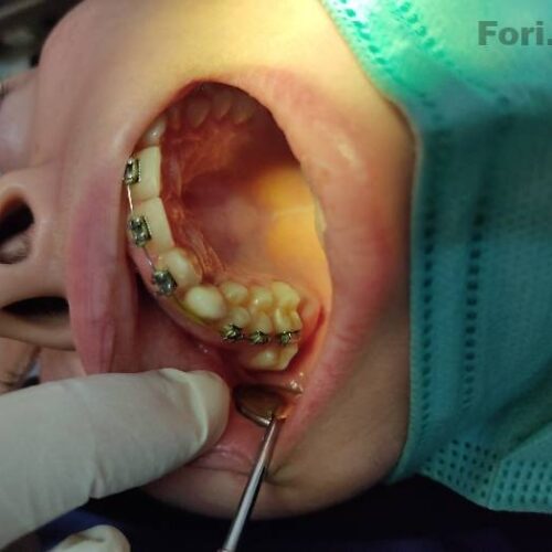 دندانپزشکی پلیمر