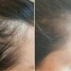 درمان قطعی کم حجمی موهاو ریزش مو