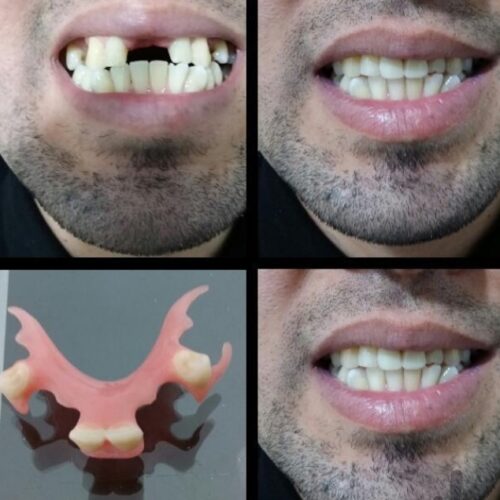 دندان مصنوعی  باکیفیت