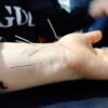 اموزش طب سوزنی و حجامت