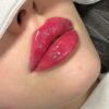 تزریق ژل فیلر بوتاکس پی ارپی میکرونیدلینگ مزوتراپی خال زگیل فشیال
