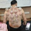 اموزش طب سوزنی و حجامت