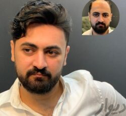 پروتز مو ، چسب پروتز و تعمیرات