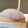 انجام کاشت مو طبیعی با روش fit صد در صد تضمینی،توسط تکنسین مجرب و حرفه ای