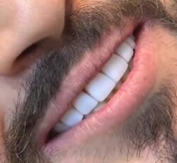 کامپوزیت دندان آلفا