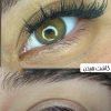 خدمات تخصصی کاشت هیدن مژه