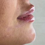 مدل ژل و بوتاکس