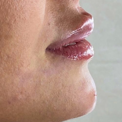 مدل ژل و بوتاکس