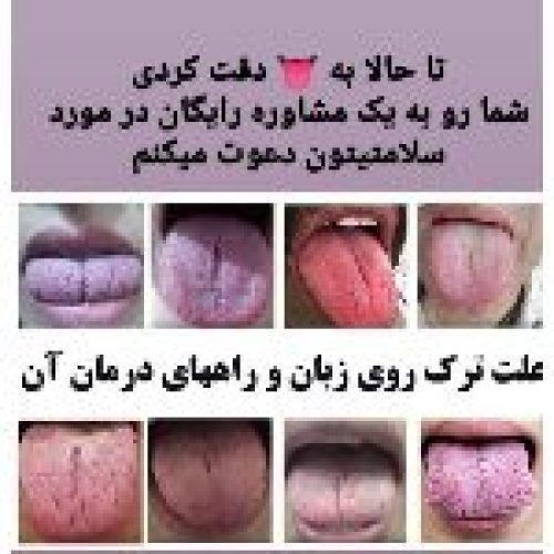 تشخیص تمام عارضه ها از روی زبان