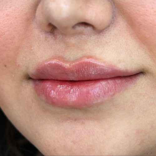 تزریق تخصصی بوتاکس و فیلر