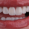 ساخت دندان مصنوعی آلمانی در بندرعباس(دندانسازی)