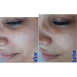 پاکسازی وفیشال پوست