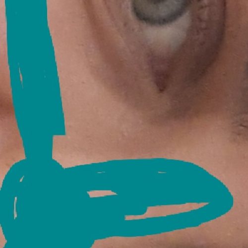 لنز رنگی طبی کره ای