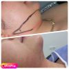 ژل بوتاکس نخ مزو خالی داری چال لپ