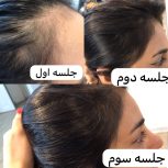 اسکراب مو (رونوفل)