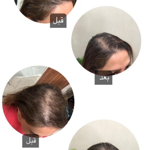 اسکراب مو (رونوفل)