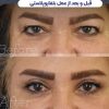 ژل بوتاکس نخ مزو خالی داری چال لپ