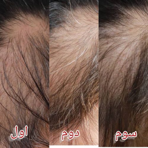 اسکراب مو (رونوفل)