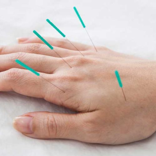 کاشت نخ لاغری