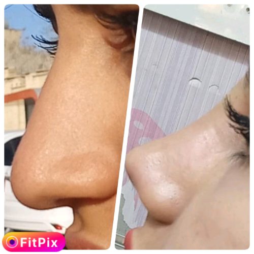 ژل بوتاکس نخ مزو خالی داری چال لپ