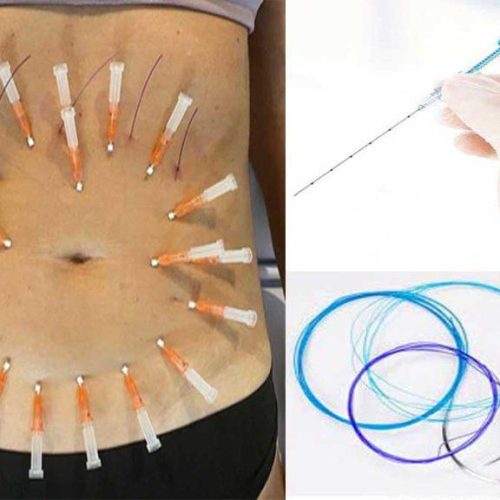 کاشت نخ لاغری