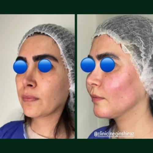ژل بوتاکس نخ مزو خالی داری چال لپ