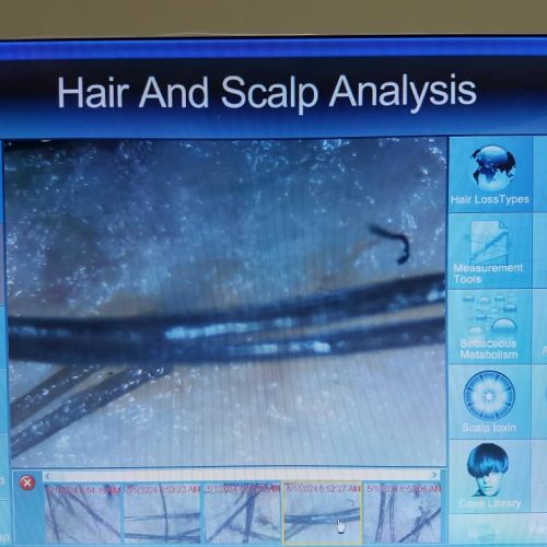 اسکراب مو (رونوفل)