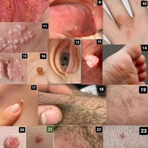 رفع زگیل و تبخال و خال گوشتی با گیاهان دارویی