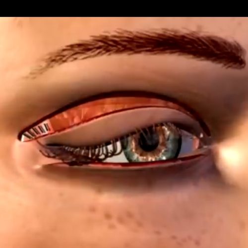 کاشت نخ لاغری