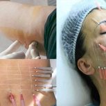 کاشت نخ لاغری