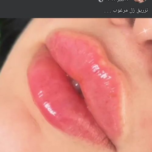 کاشت نخ لاغری