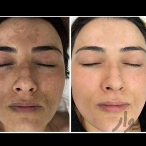 کرم سفید کننده گیاهی بی نظیر وضمانتی