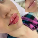 ژل بوتاکس نخ مزو خالی داری چال لپ