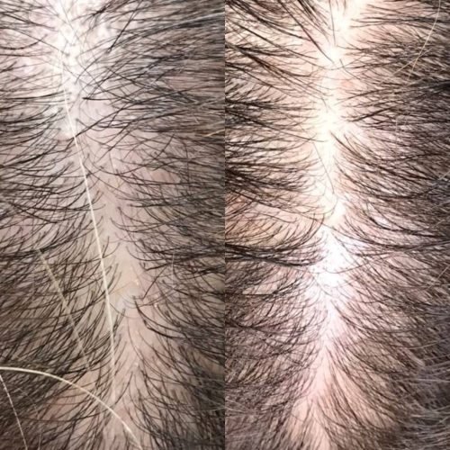 اسکراب مو (رونوفل)