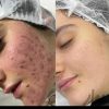 کرم سفید کننده گیاهی بی نظیر وضمانتی