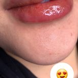 ژل لب و بوتاکس