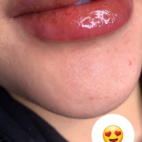 ژل لب و بوتاکس