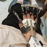 اتل فلزی  فنی ارتوپدی