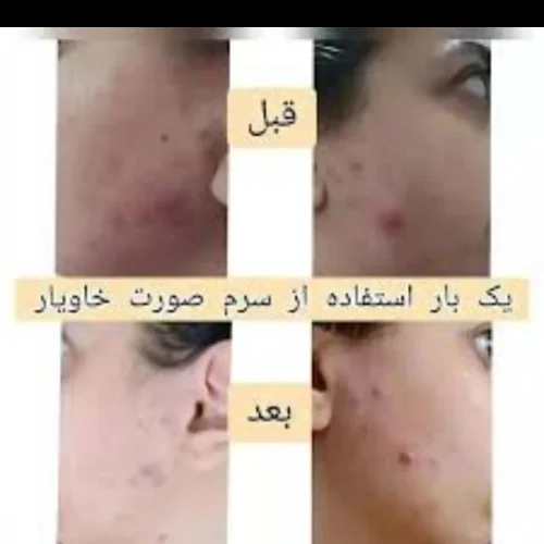 ماسک ضد جوش انواع تمام محصولات مراقبتی پوست مو موجوده