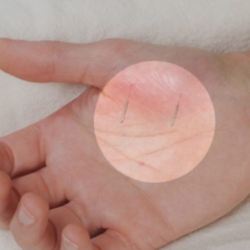 طب درمانی سنتی وسوزن درمانی