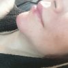دوره ژل و بوتاکس نخ مزو هایفو