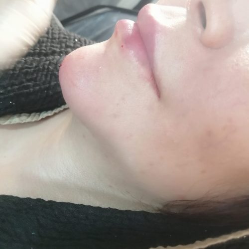 دوره ژل و بوتاکس نخ مزو هایفو
