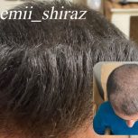 کاشت مو وابروی تخصصی