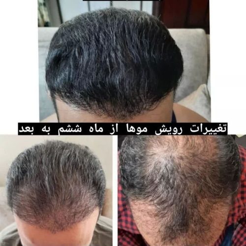 کاشت مو وابروی تخصصی