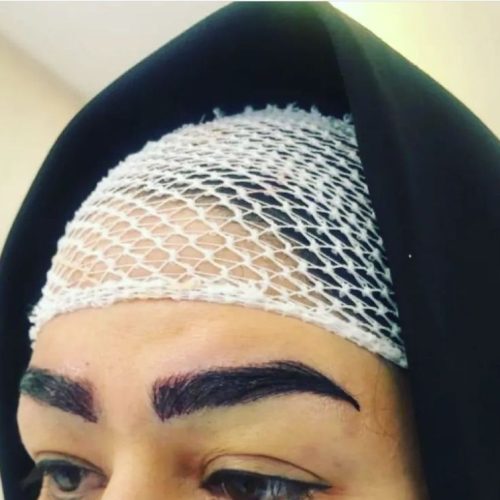 کاشت مو وابروی تخصصی