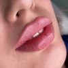 تزریق ژل و بوتاکس درجه یک