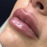 تزریق ژل و بوتاکس درجه یک