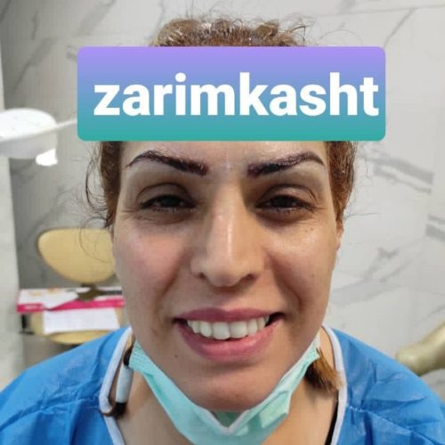 کاشت ابرو ومو
