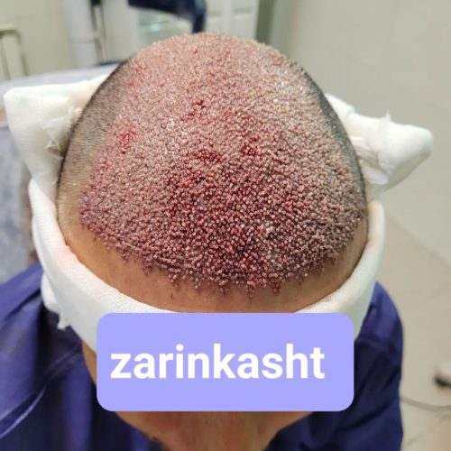 کاشت ابرو ومو