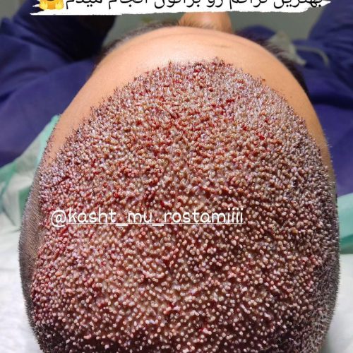 کاشت  طبیعی مو